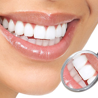 dental-veneers