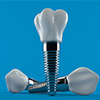 turkey-dental-implants