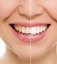 antalya teeth-whitening